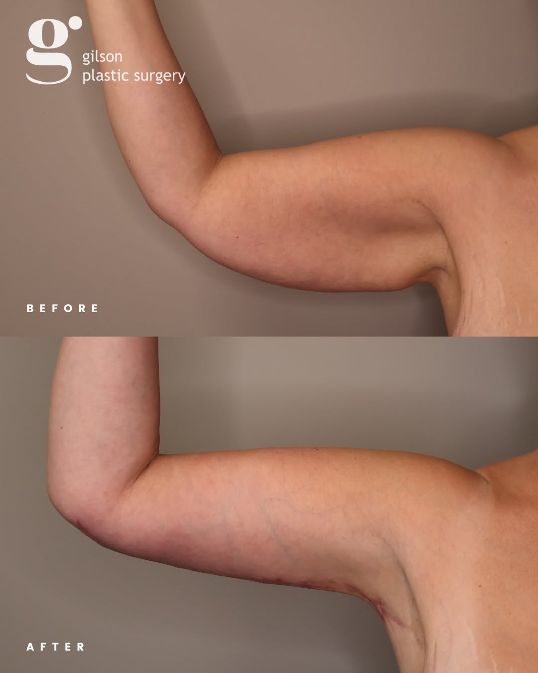 Instagram post by Dr. Aaron Gilson, DO: Before and after a transformative brachioplasty (arm lift). For many of our patients at Gilson Plastic Surgery, the goal isn't just a physic…