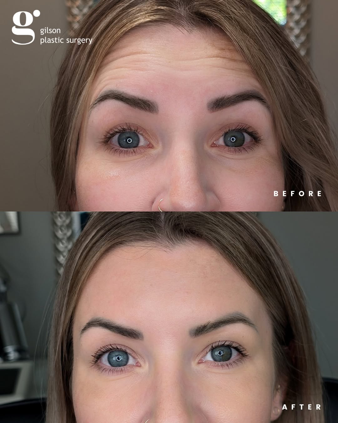 Instagram post by Dr. Aaron Gilson, DO: A beautiful before-and-after demonstrating the power of a customized neuromodulator treatment. During our consultation, we discussed her spe…