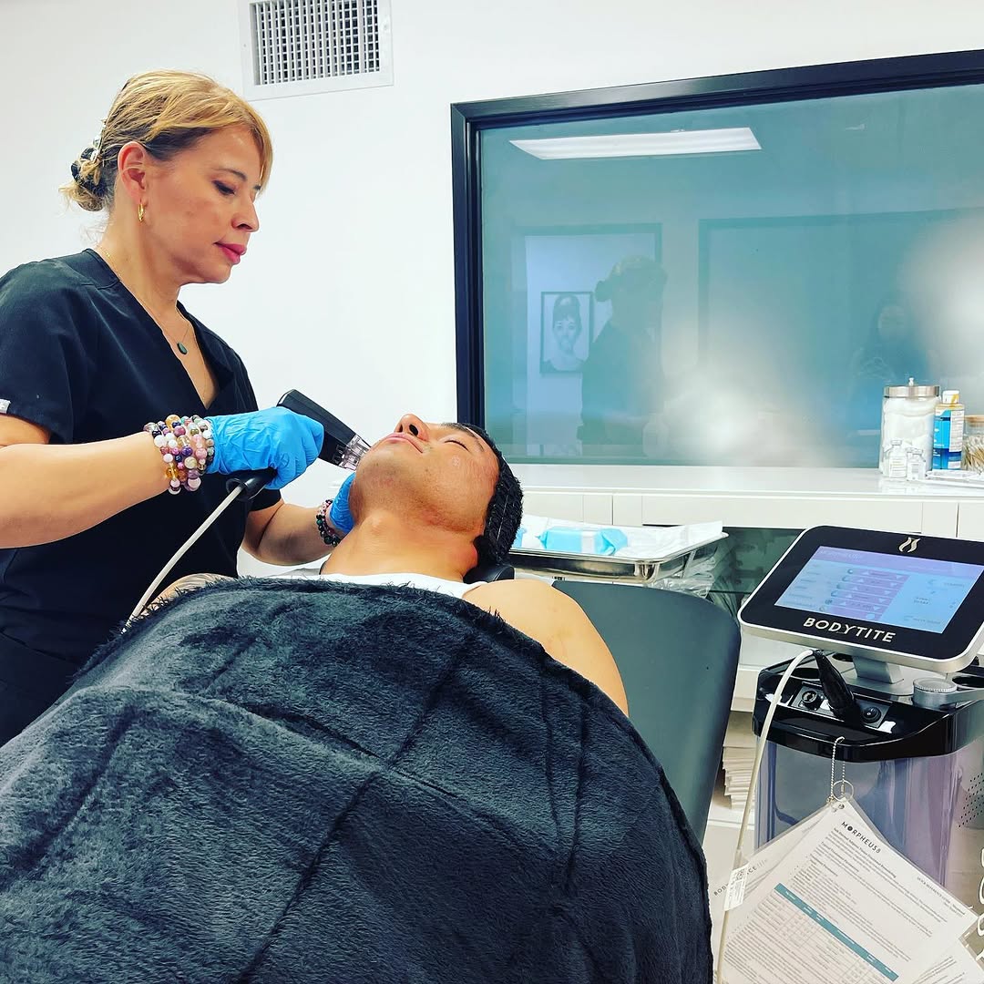 Instagram post by Dr. Aaron Jeng: Deep Acne Scars treatment with Morpheus8 #aaronjengmd #morpheus8 #inmode #acnescarsremoval