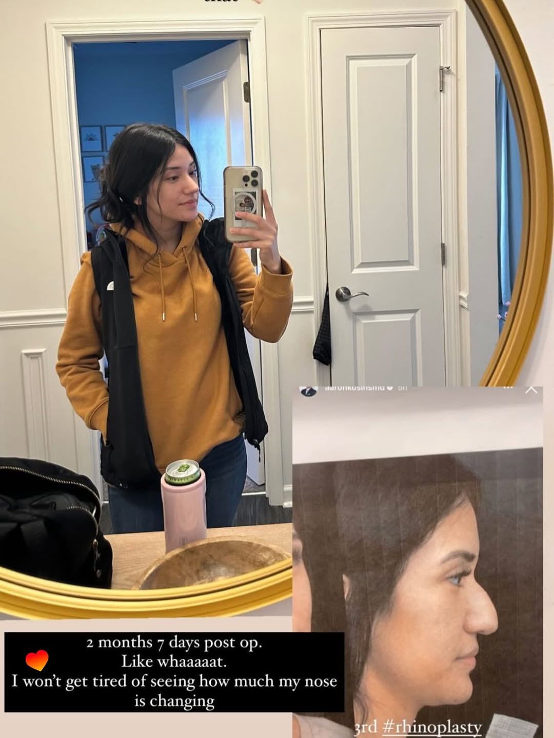 Instagram post by Dr. Aaron Kosins: 2️⃣ months VERSUS 3️⃣ years RHINOPLASTY I am so lucky that patients continue to update me and send me photos years after their #rhinoplasty …