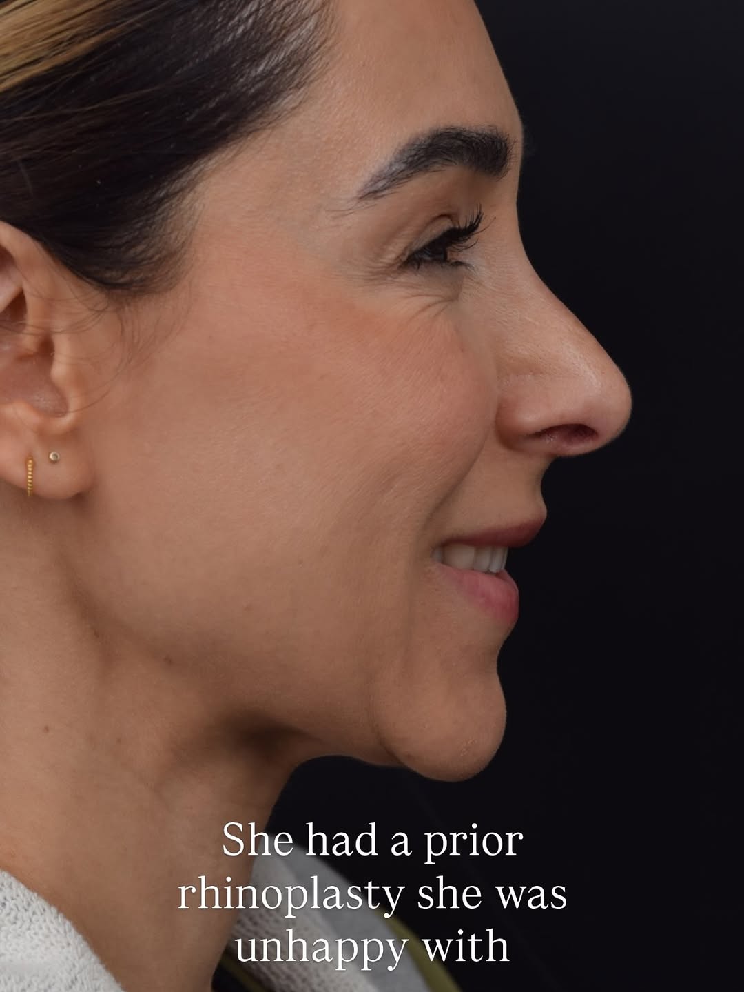 Instagram post by Dr. Aaron Kosins: #RevisionRhinoplasty 1 Year PostOp It is common for me to see patients with both #aesthetic and functional issues after a prior #rhinoplasty…