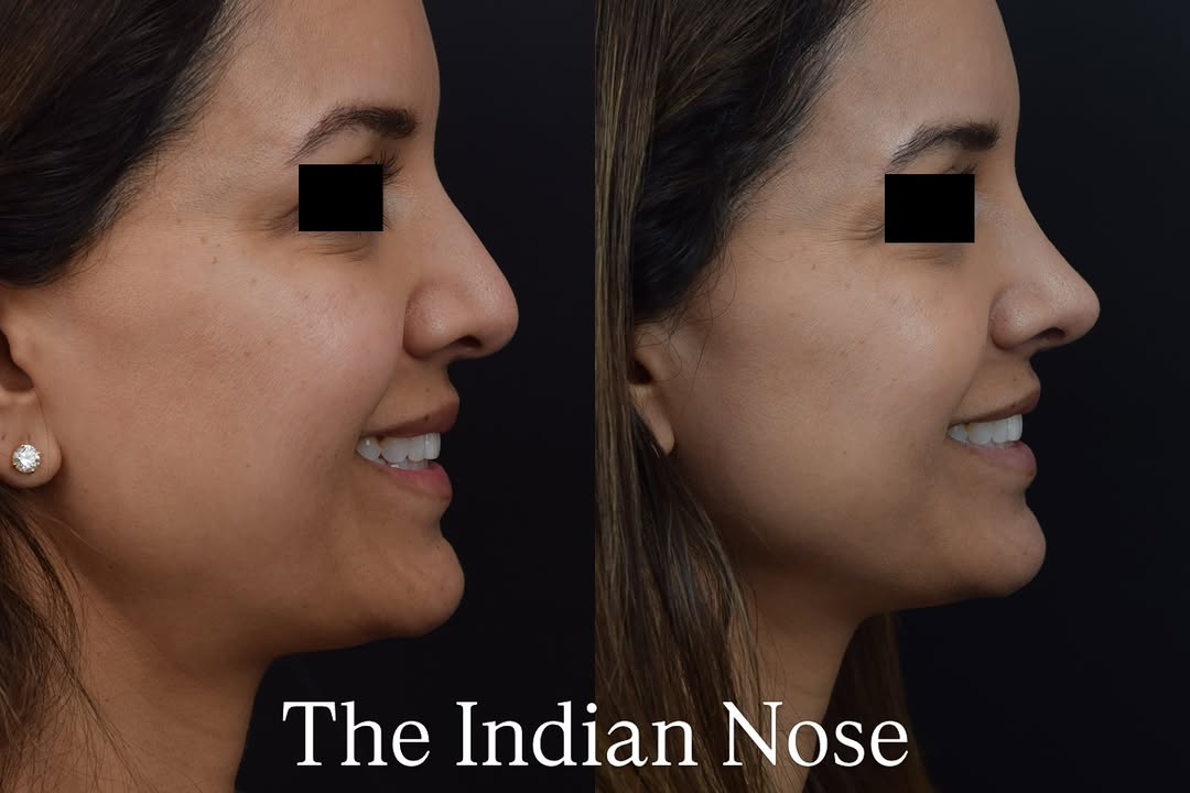 Instagram post by Dr. Aaron Kosins: The #Indian Nose #Rhinoplasty In my practice, I have many patients who are Indian, Afghani, Pakistani, and Bengali. These patients tend to h…