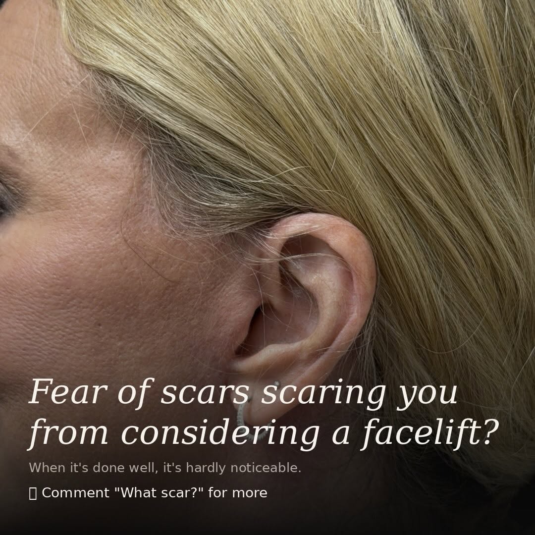 Instagram post by Dr. Adam Bryce Weinfeld: It's one of the most common concerns I hear — and honestly, a fair one. But when a facelift is performed carefully, with attention to incisi…