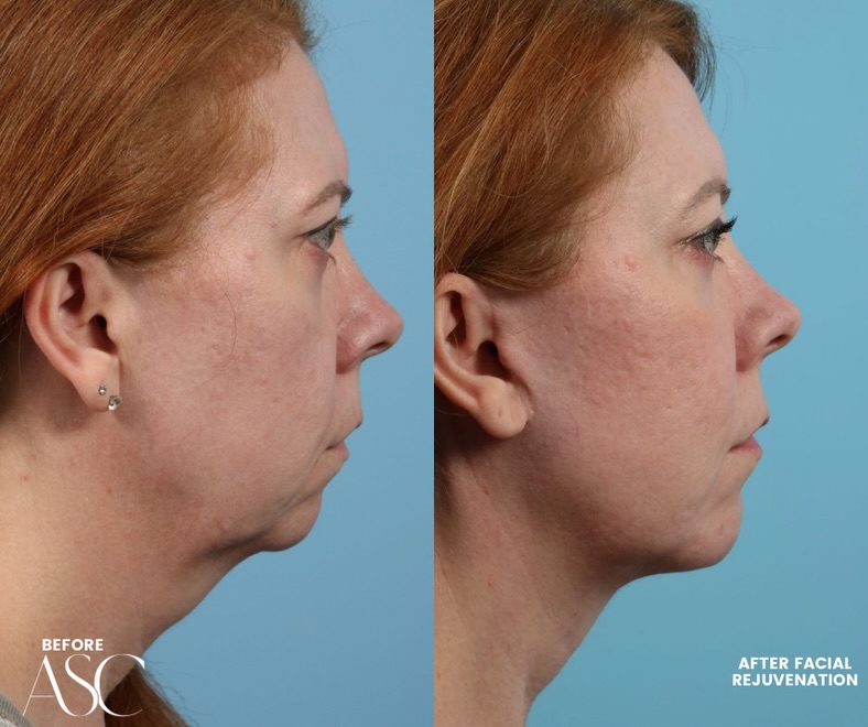 Instagram post by Dr. Adam C. Augenstein: The power of combination procedures. Facial aging rarely happens in just one area—which is why comprehensive facial rejuvenation can make su…