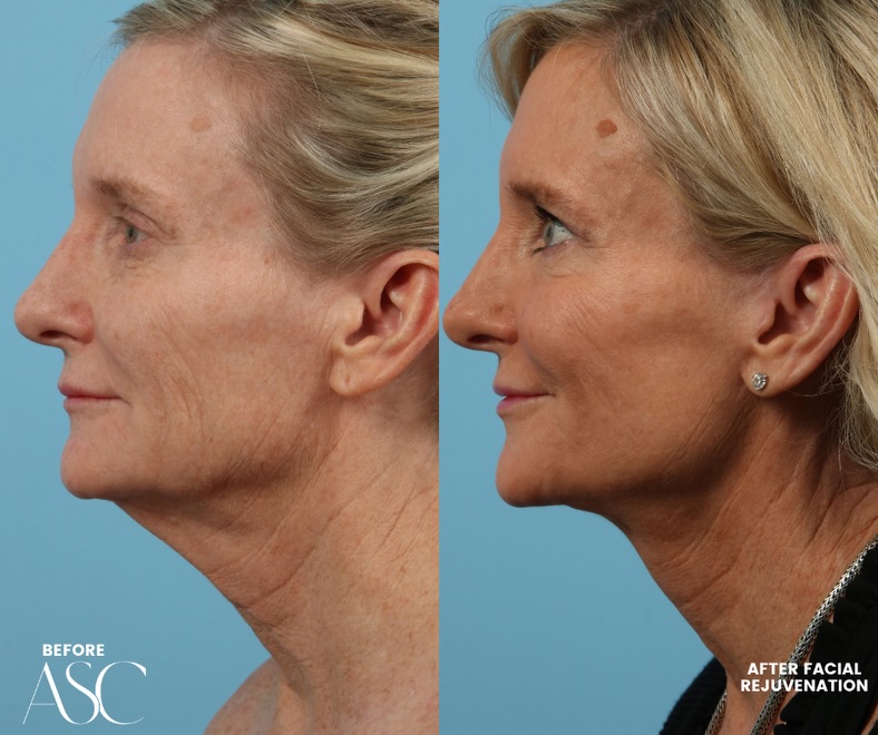 Instagram post by Dr. Adam C. Augenstein: Natural results with a refreshed profile. 🤍 This patient’s facelift was designed to restore definition through the lower face and jawline w…