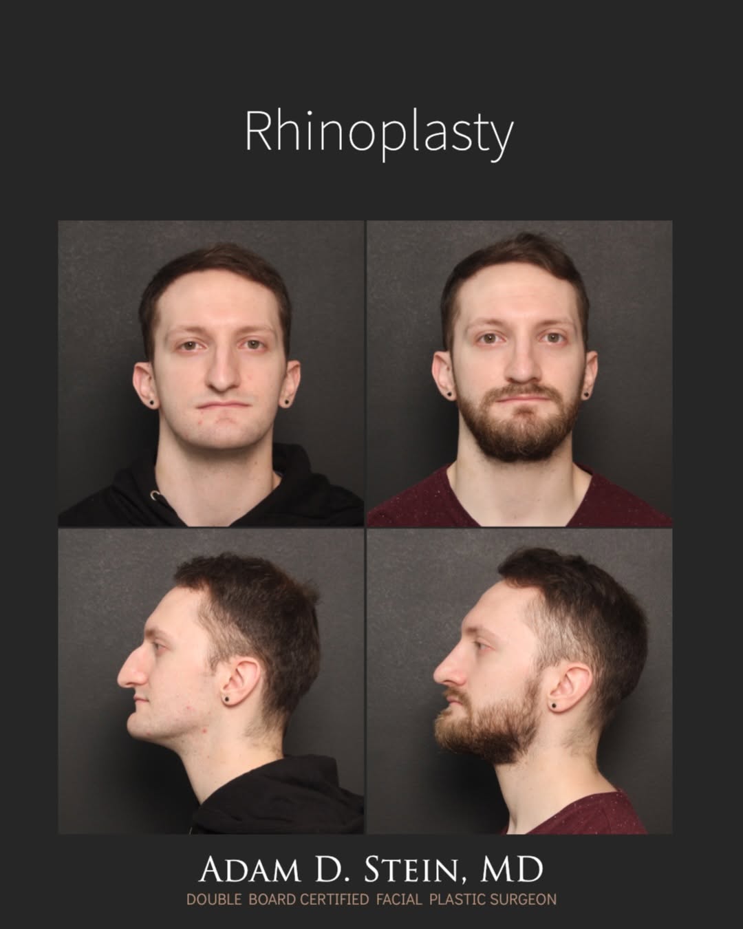 Instagram post by Dr. Adam D. Stein: Stronger profile. Better balance. 💪 This male rhinoplasty addressed a prominent dorsal hump and droopy nasal tip, creating a cleaner, more …