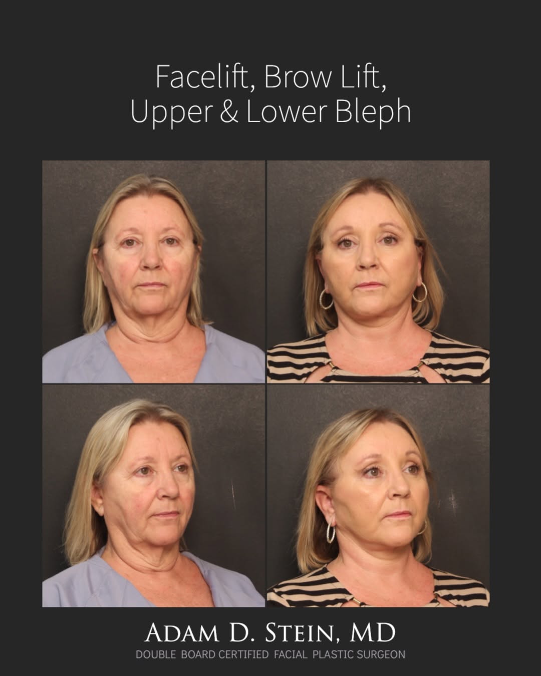 Instagram post by Dr. Adam D. Stein: One of Dr. Stein’s most remarkable facial rejuvenation transformations. ✨ This patient underwent a facelift, brow lift, and upper and lower …