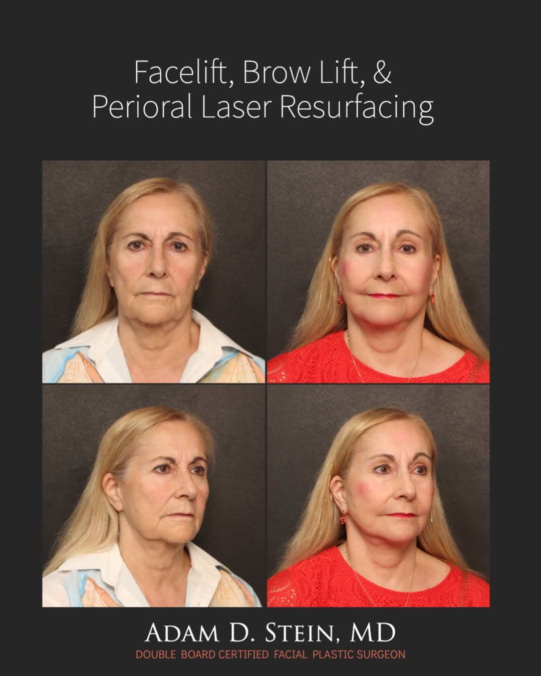 Instagram post by Dr. Adam D. Stein: A refreshed, balanced result without looking overdone. ✨ For this woman in her 60s, Dr. Stein combined a facelift and brow lift to restore d…