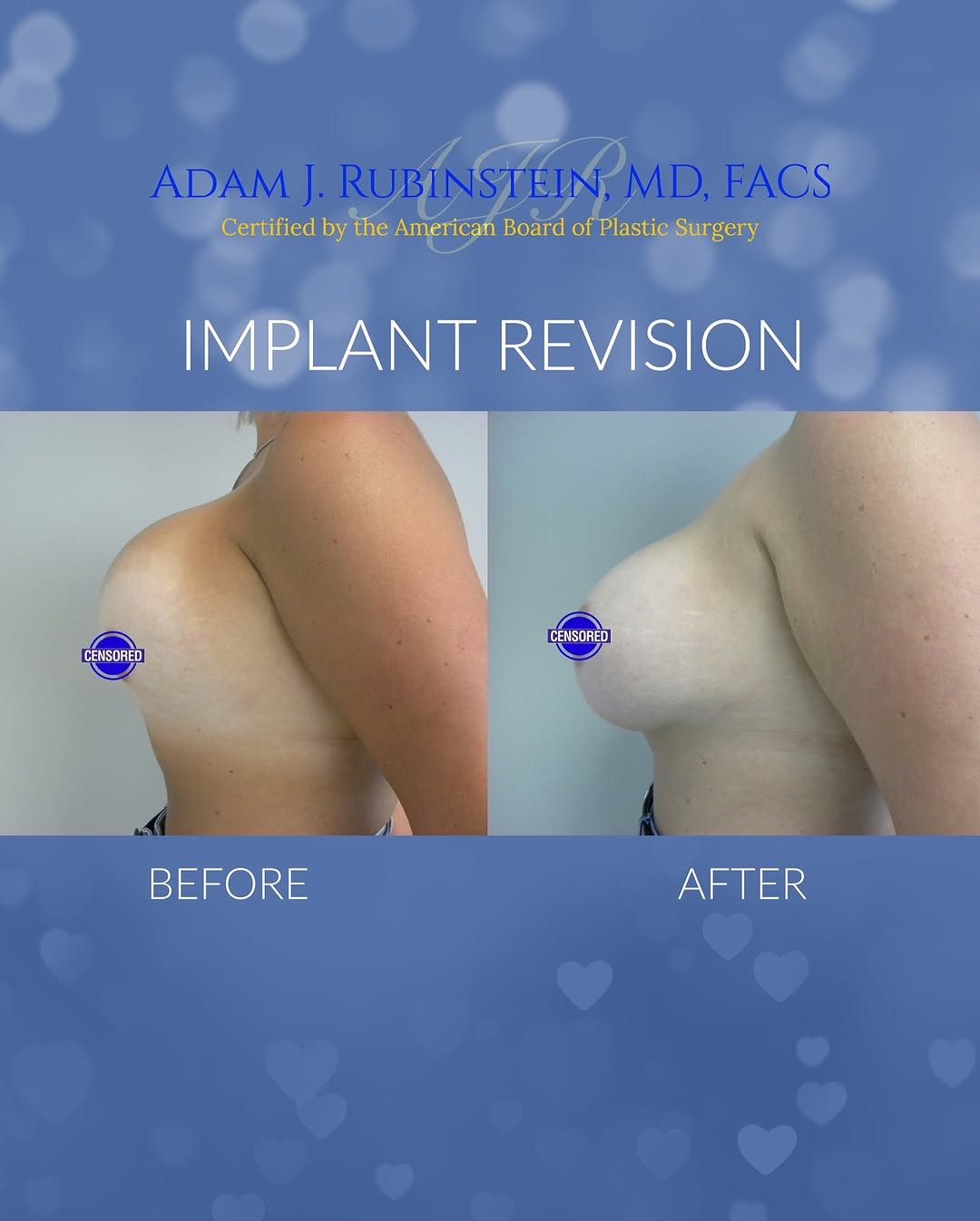 Instagram post by Dr. Adam Rubinstein: I have the privilege to perform a lot of revision surgery in my practice, and I really like it. Revisions give me an opportunity to change a…
