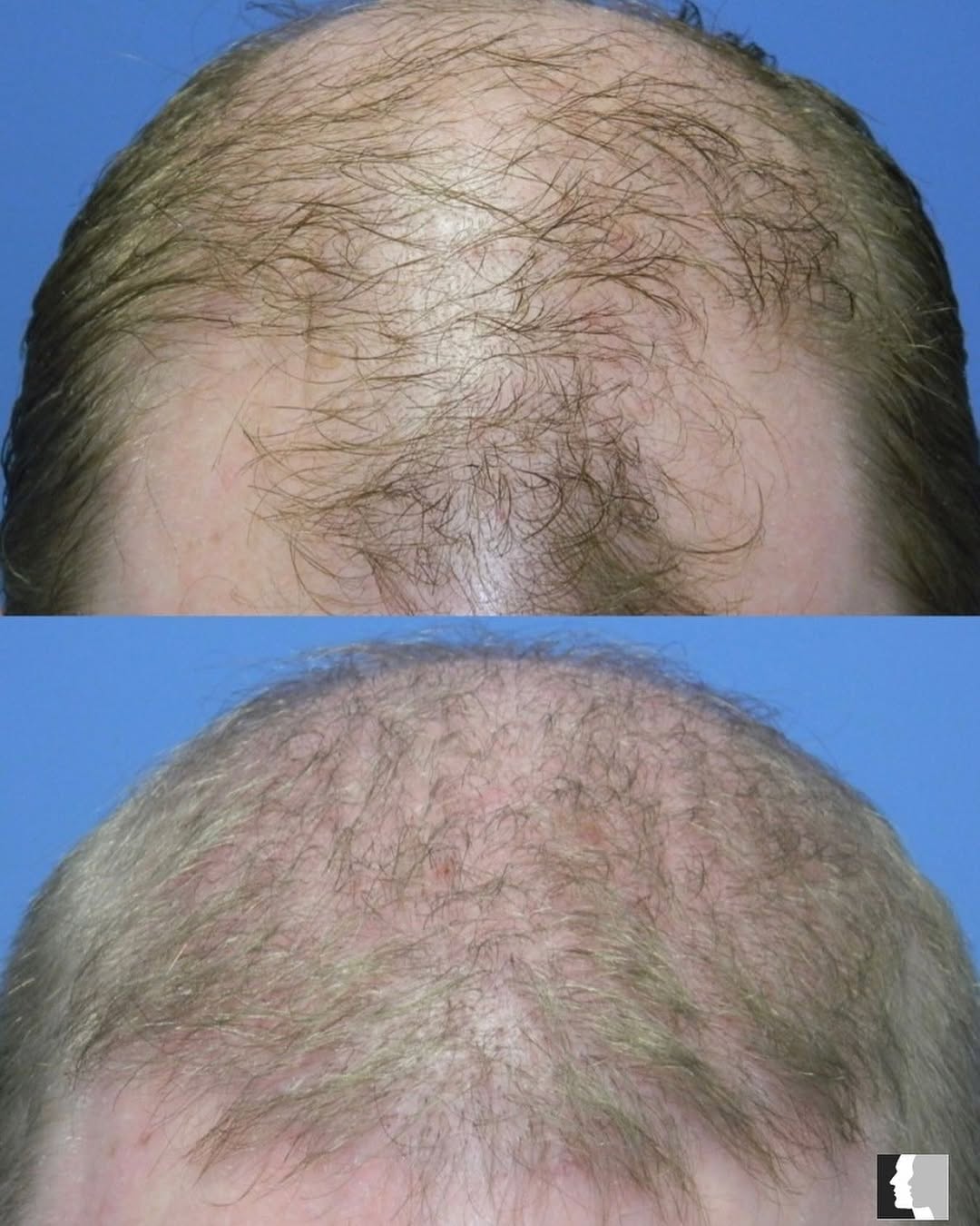 Instagram post by Dr. Adrian Yi: Before and After results from a Hair Transplant! 📞Call (818) 986-7900 to book a consultation for more information! • • • #hairtransformatio…