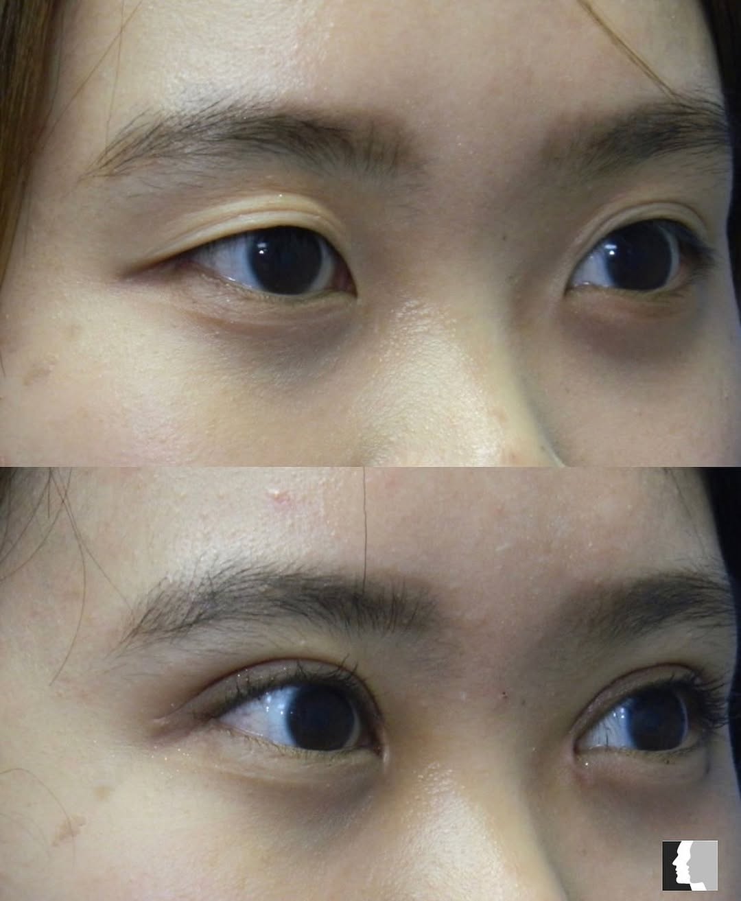 Instagram post by Dr. Adrian Yi: Before and After results from Upper Blepharoplasty! 📞Call (818) 986-7900 to book a surgical consultation for more information! • • • #bleph…
