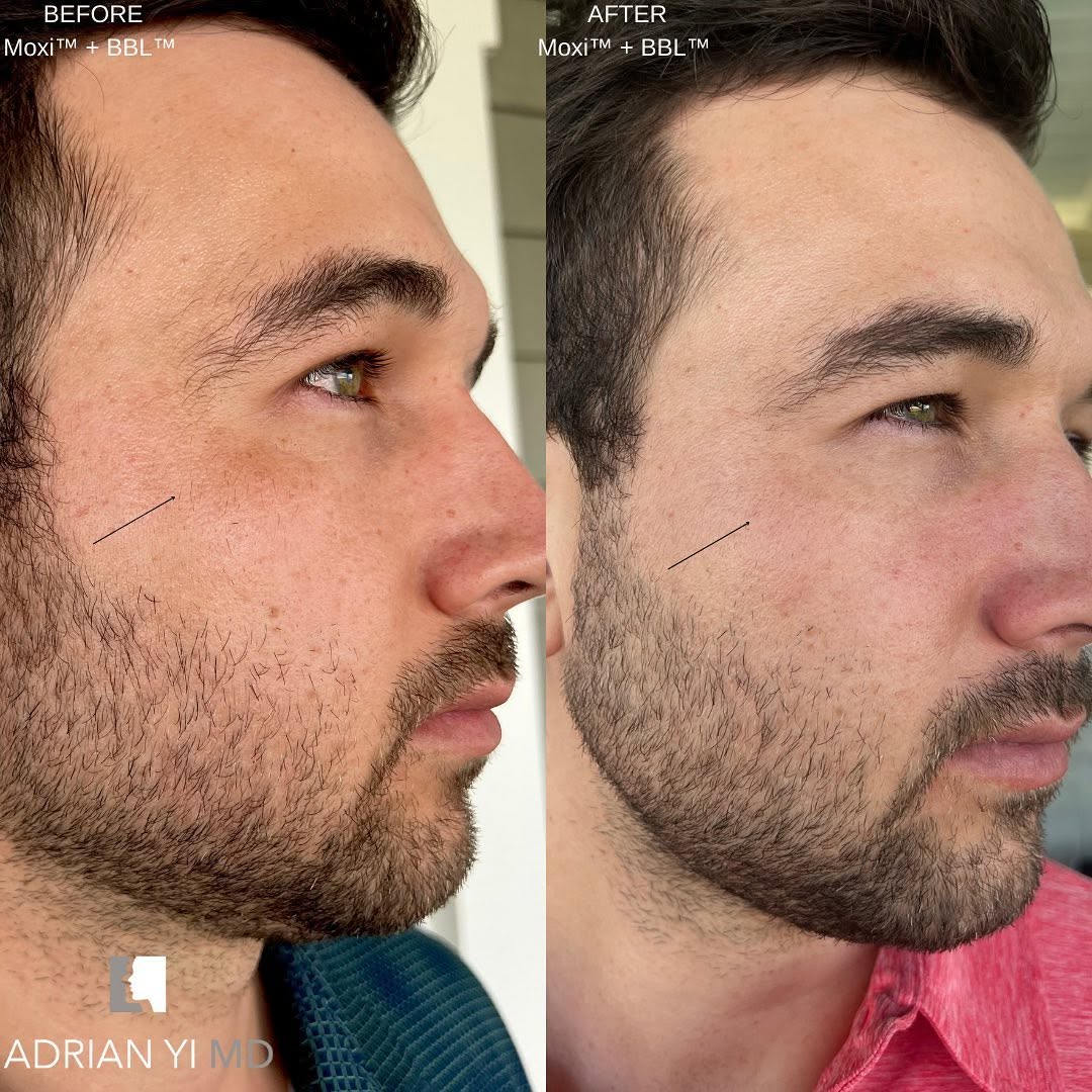Instagram post by Dr. Adrian Yi: MOXI +BBL is an amazing laser combination for anyone and any type of skin! MOXI can treat any area of the face regardless of any facial hair…