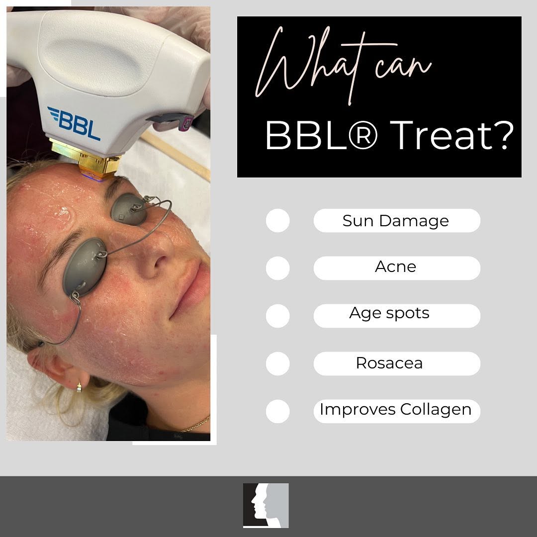 Instagram post by Dr. Adrian Yi: The BBL laser generates new skin cells and collagen production for better anti-aging results. ‼️Laser packages now available‼️ 📞Call (818) …