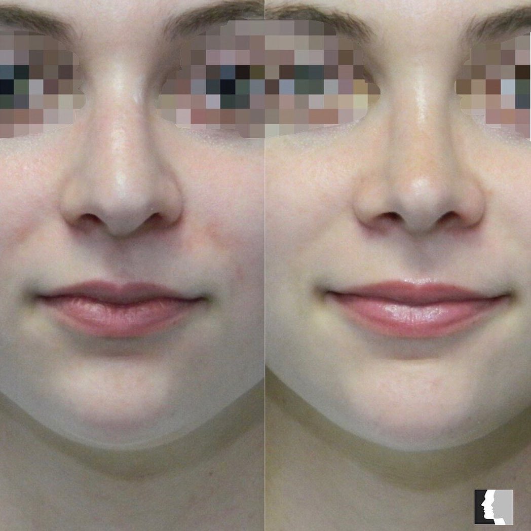 Instagram post by Dr. Adrian Yi: Before and After results from a Rhinoplasty! 📞Call (818) 986-7900 to book a surgical consultation for more information! • • • #rhinoplasty …