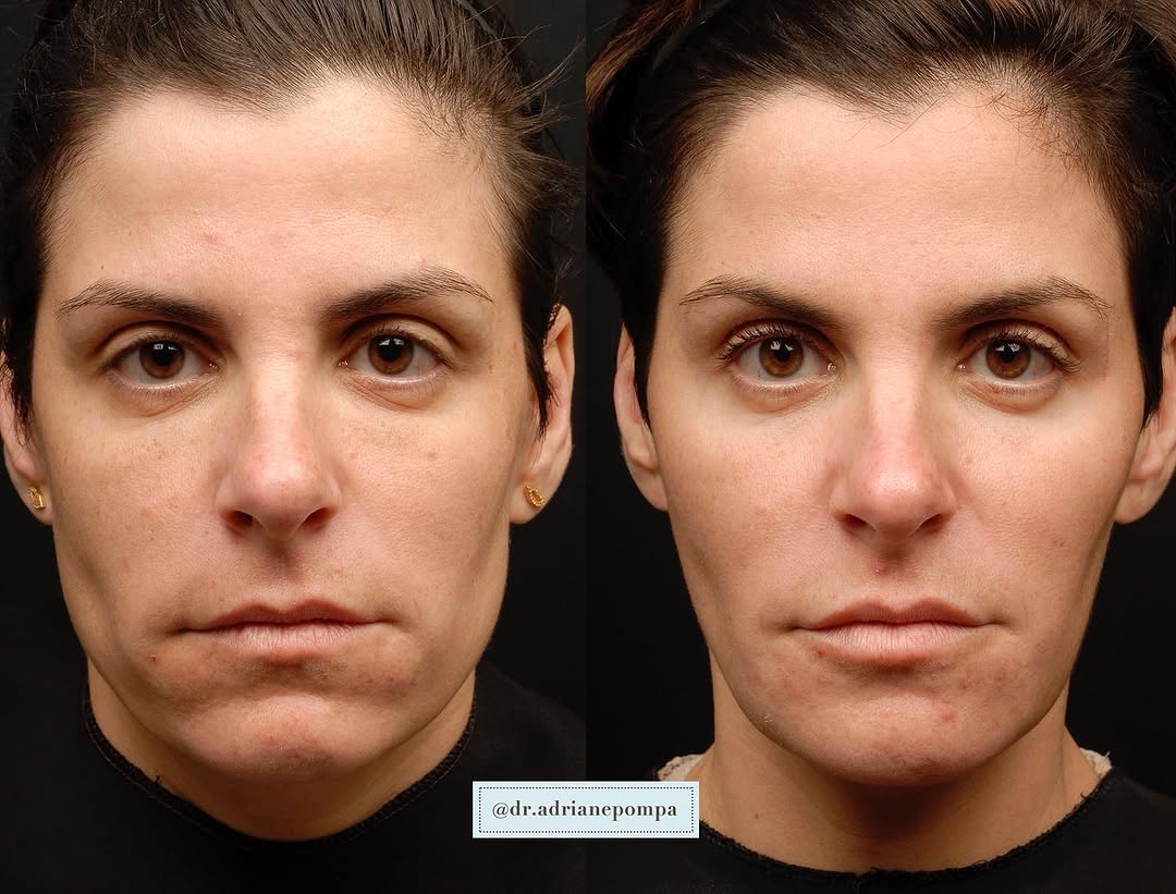 Instagram post by Dr. Adriane Pompa: 5 years later and still looking 🔥. With facial reshaping, balancing, and tweaking, we can stay looking the same, and even better, over time…
