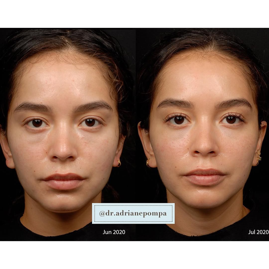 Instagram post by Dr. Adriane Pompa: Subtle results are my favorite 💗 When getting cosmetic treatments, people should ask if you’ve been on vacation etc, not “what filler did y…
