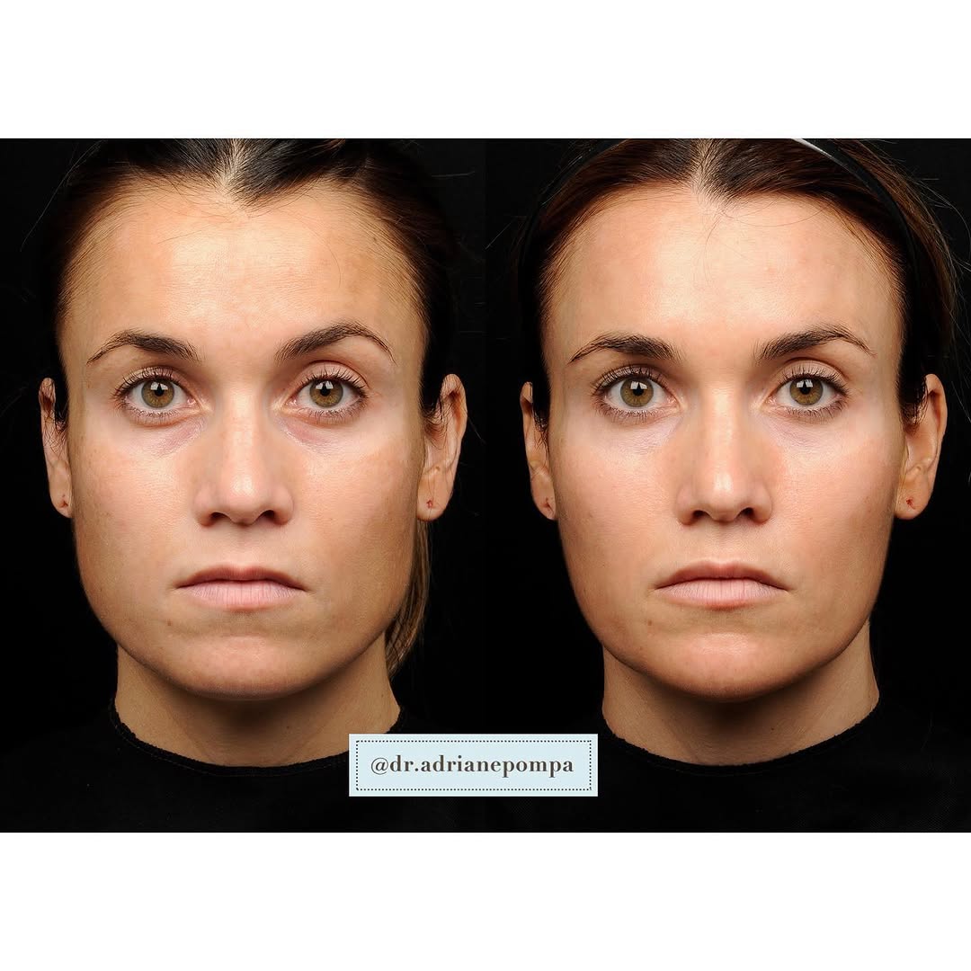 Instagram post by Dr. Adriane Pompa: Nothing feels better than giving a mommy makeover- this already gorgeous patient and new mom had a little filler everywhere (cheeks, temples…