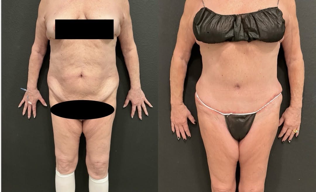 Instagram post by Dr. Aileen Caceres: One of the most common things I hear: "I lost the weight... but my belly never went away." Weight loss is incredible, but stretched skin, we…