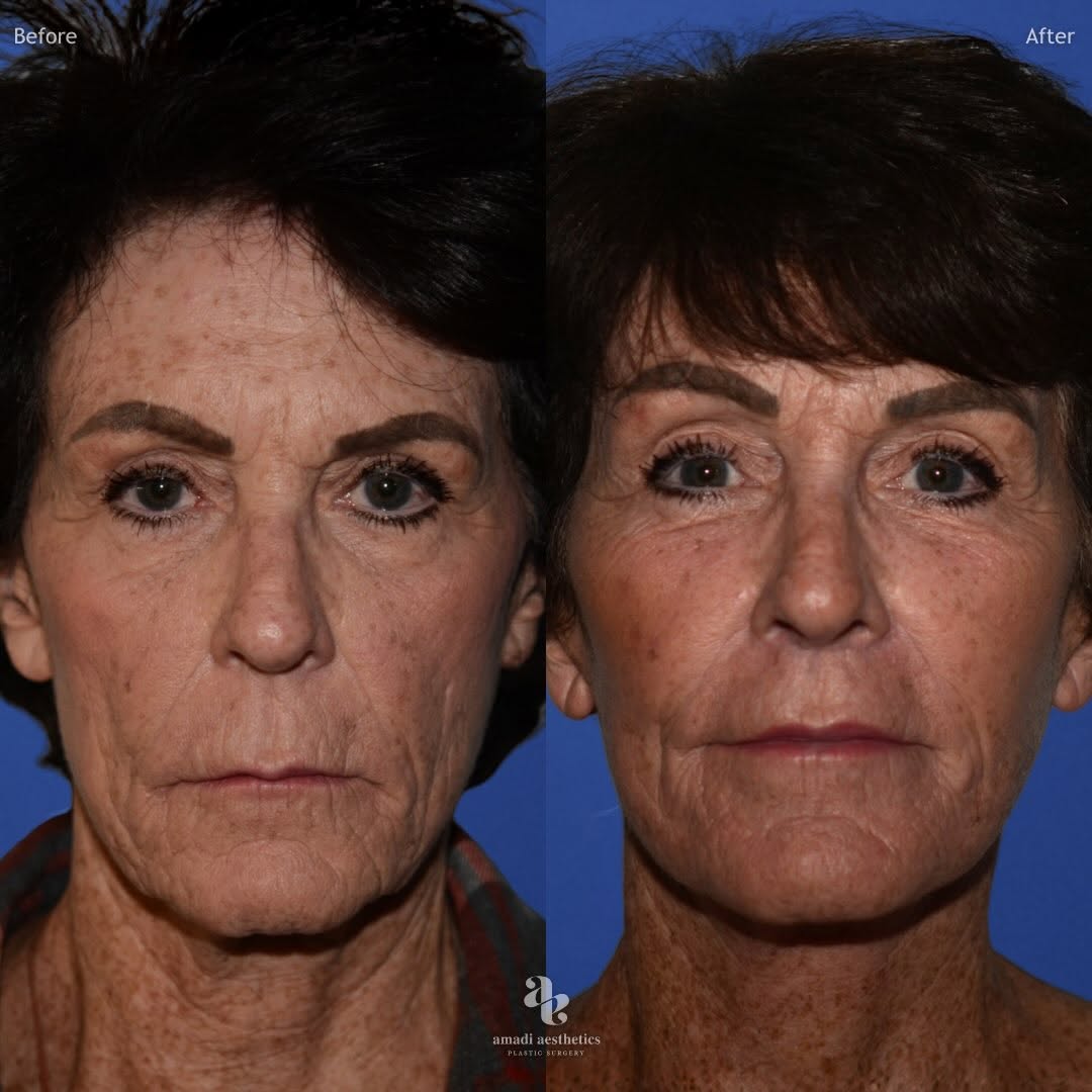 Instagram post by Dr. A.J. Amadi: A comprehensive refresh, thoughtfully staged. ✨ This 66-year-old patient underwent full face rejuvenation to address multiple areas of facia…