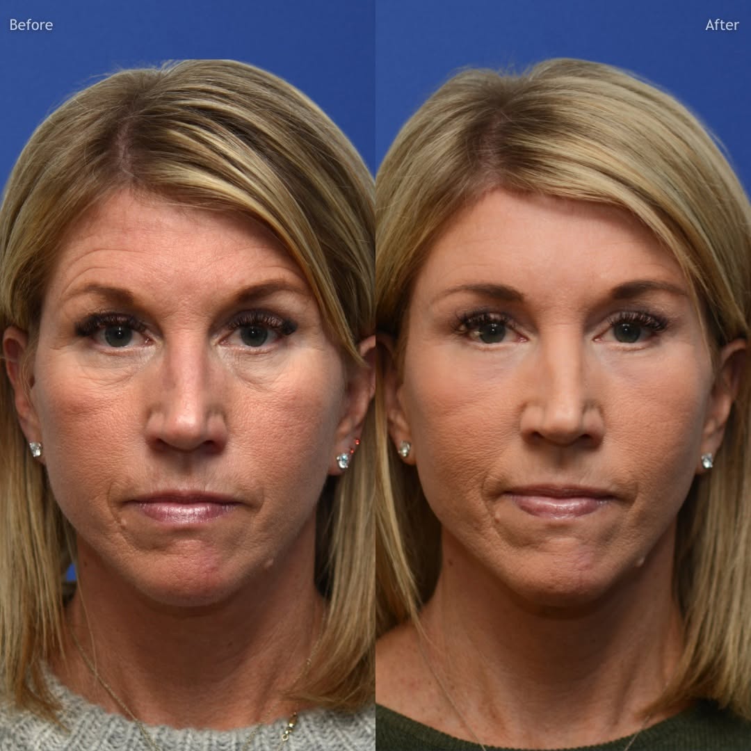 Instagram post by Dr. A.J. Amadi: Trichophytic brow lift, lower blepharoplasty with fat repositioning, and periocular Amadi Peel ✨ by Dr. Amadi The Amadi Peel - a surgeon's g…