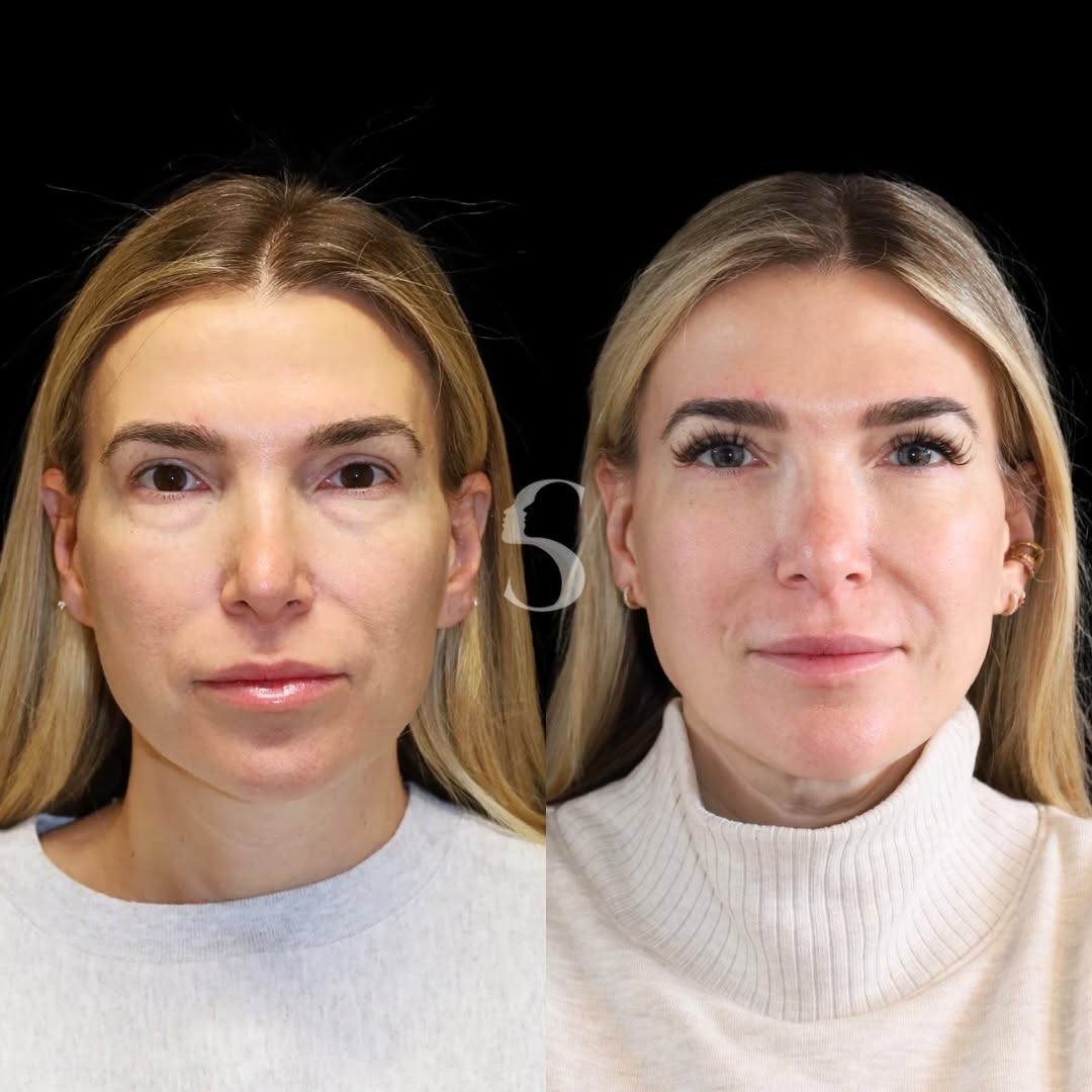 Instagram post by Dr. Akshay Sanan: Makeup doesn’t fix under eye bags. It often makes them more noticeable. This is where surgery makes the difference: Lower blepharoplasty tri…