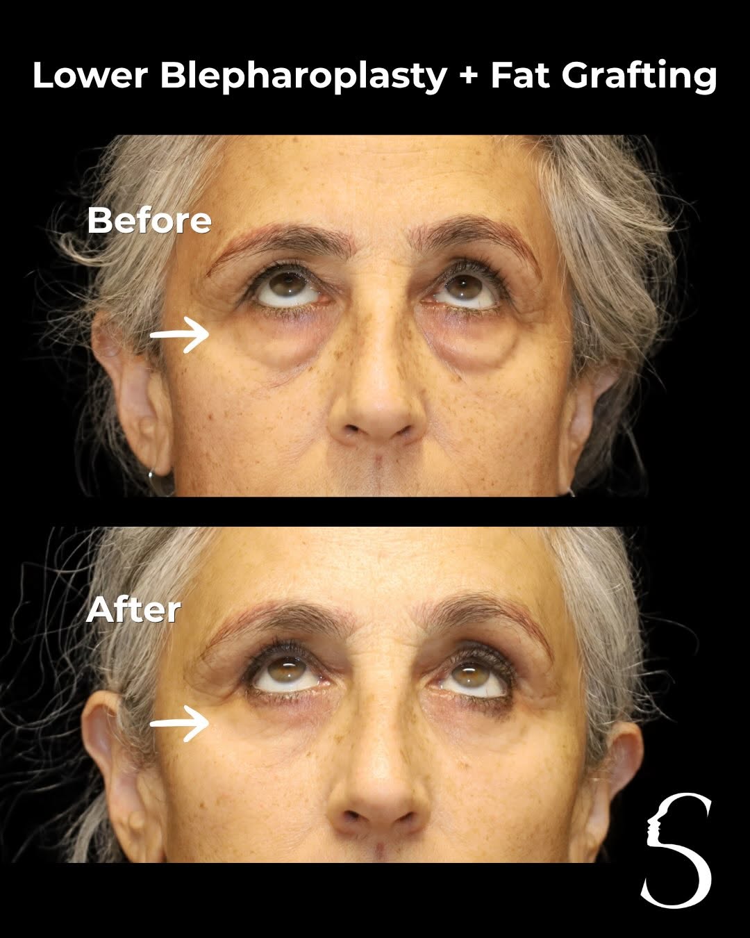 Instagram post by Dr. Akshay Sanan: The best results are the ones that simply make you look well-rested. ✅Lower Blepharoplasty ✅Fat Grafting To see me as a patient, please book…