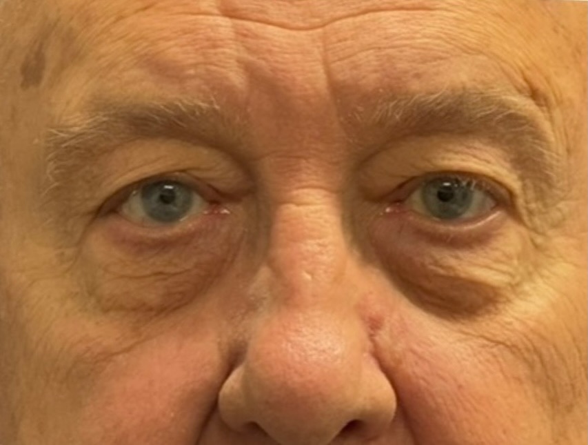 Instagram post by Dr. Albert Dabbah: A more rested, youthful appearance, without changing what makes him look like himself. This male upper and lower blepharoplasty helped reduc…