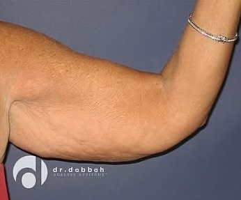 Instagram post by Dr. Albert Dabbah: Summer is the time for wearing as little as possible and that often brings some reservations about summer-ready arms and shoulders. Especial…
