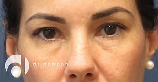 Instagram post by Dr. Albert Dabbah: Due to the delicate nature of the skin surrounding the eyes, it is often the first area to show signs of aging. Over time, fine lines and wr…