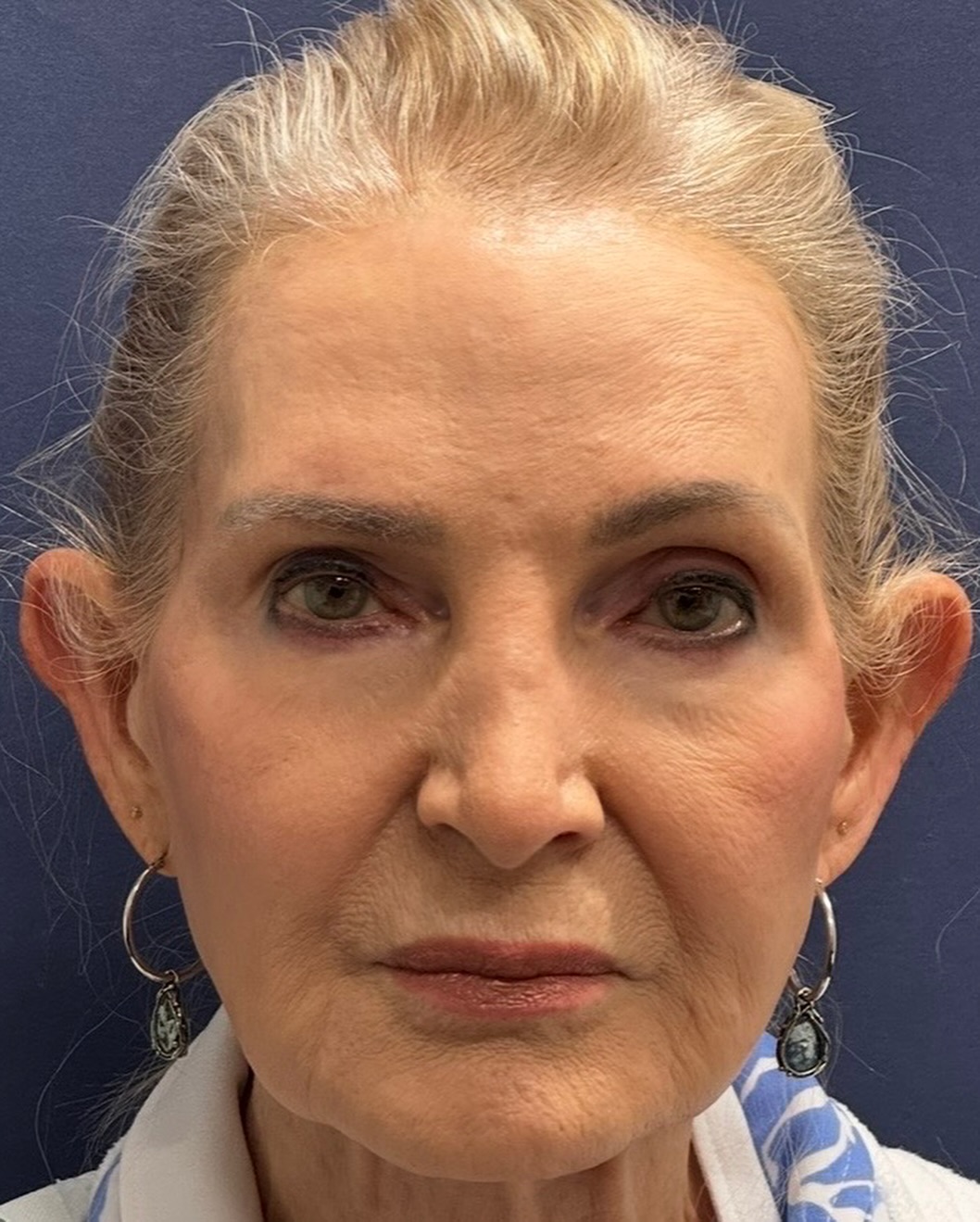 Instagram post by Dr. Albert Dabbah: Sometimes a subtle change can make an incredible difference. This patient underwent otoplasty to reposition prominent ears and create a more…