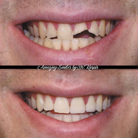 Instagram post by Dr. Albert Kurpis: TRAUMATIC INJURY SMILE RESTORED⁠ A sudden injury to the upper front teeth can instantly change someone’s smile and their confidence. This pa…