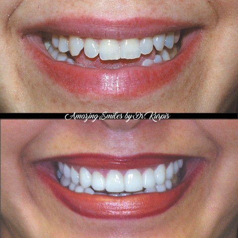 Instagram post by Dr. Albert Kurpis: WANTED A RADIANT SMILE ✨⁠ ⁠ She came in wanting more even teeth and a truly dazzling smile… and walked out with so much more.⁠ ⁠ With a full…