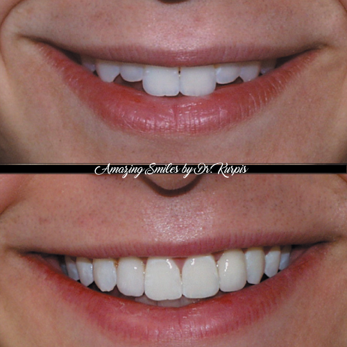 Instagram post by Dr. Albert Kurpis: Sometimes it’s the smallest details that make the biggest difference in a smile. In this case, short maxillary lateral incisors made the two…