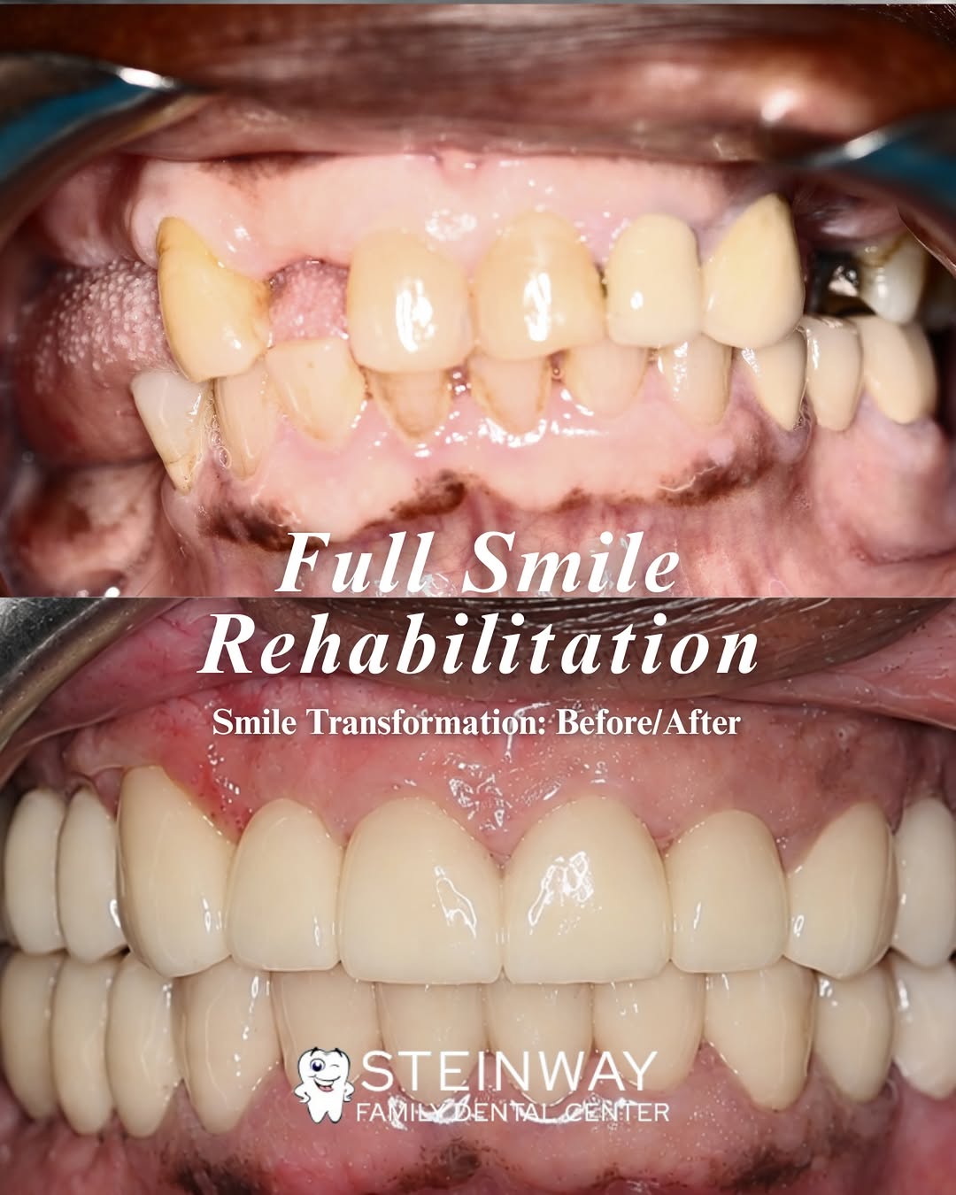 Instagram post by Dr. Aleksandr Dayanayev, DDS: For this patient, we: • Removed old, failing restorations • Restored damaged teeth • Closed spaces between teeth • Rebuilt areas affected by…