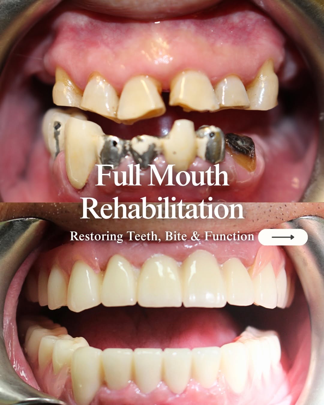 Instagram post by Dr. Aleksandr Dayanayev, DDS: This case was about much more than a smile transformation. The patient came in with a severely collapsed bite, extensive tooth structure los…