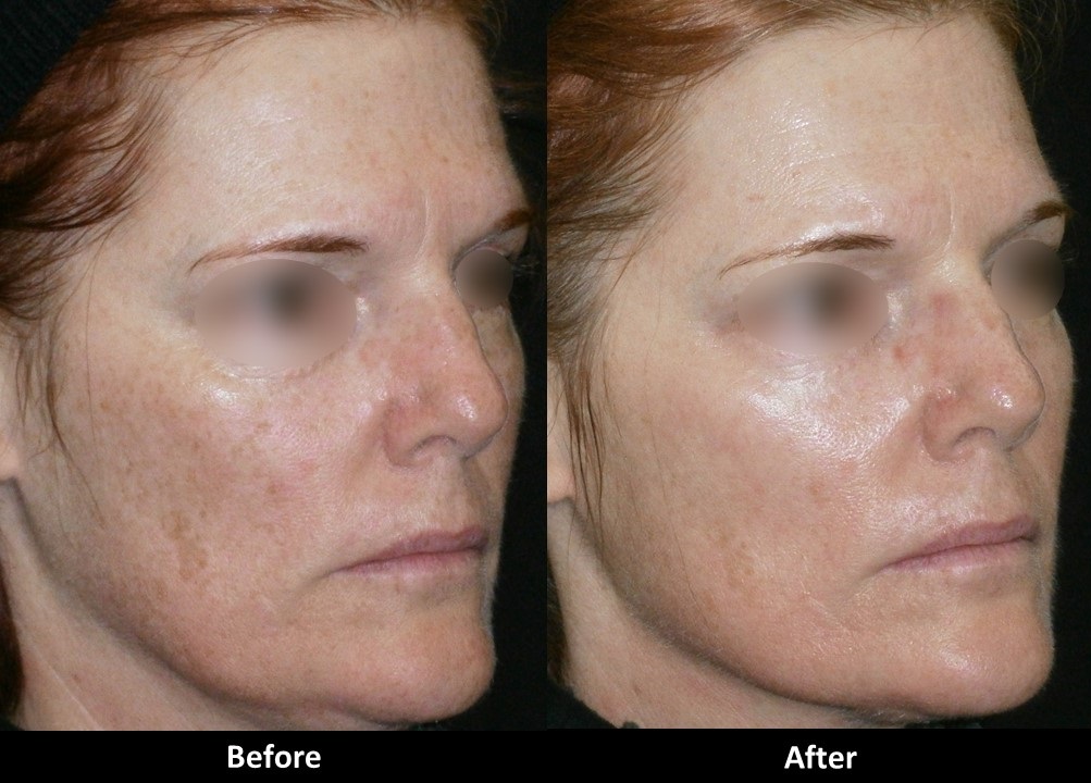 Instagram post by Dr. Alex Eshaghian: **Brighter. Smoother. More radiant. ✨** This before-and-after shows the improvement achieved with our **Red Carpet Peel**—a treatment design…