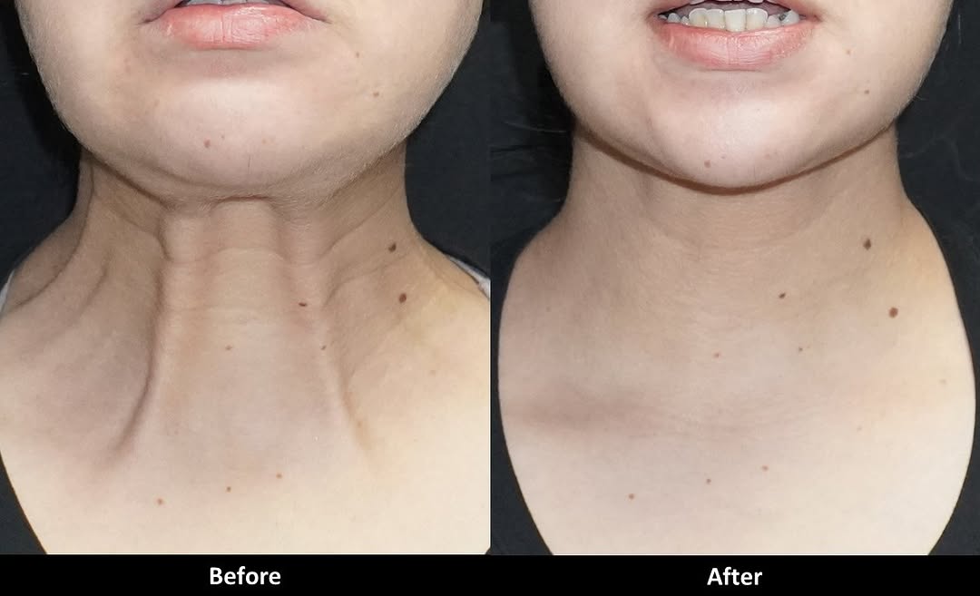 Instagram post by Dr. Alex Eshaghian: **Neck bands can age the neck—even when the skin still looks great. ✨** These vertical lines are caused by the **platysma muscles**, which c…