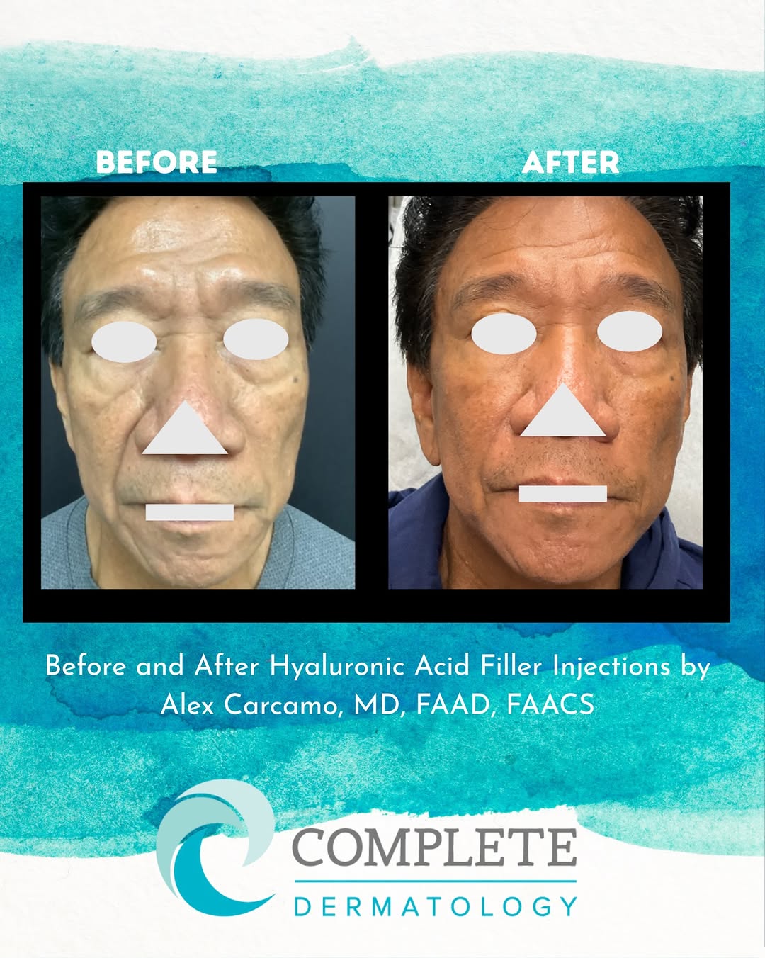 Instagram post by Dr. Alex S. Carcamo: Superb results with Hyaluronic Acid Filler Injections. #beforeandafter #fillers #aesthetics #dermatology #skingoals