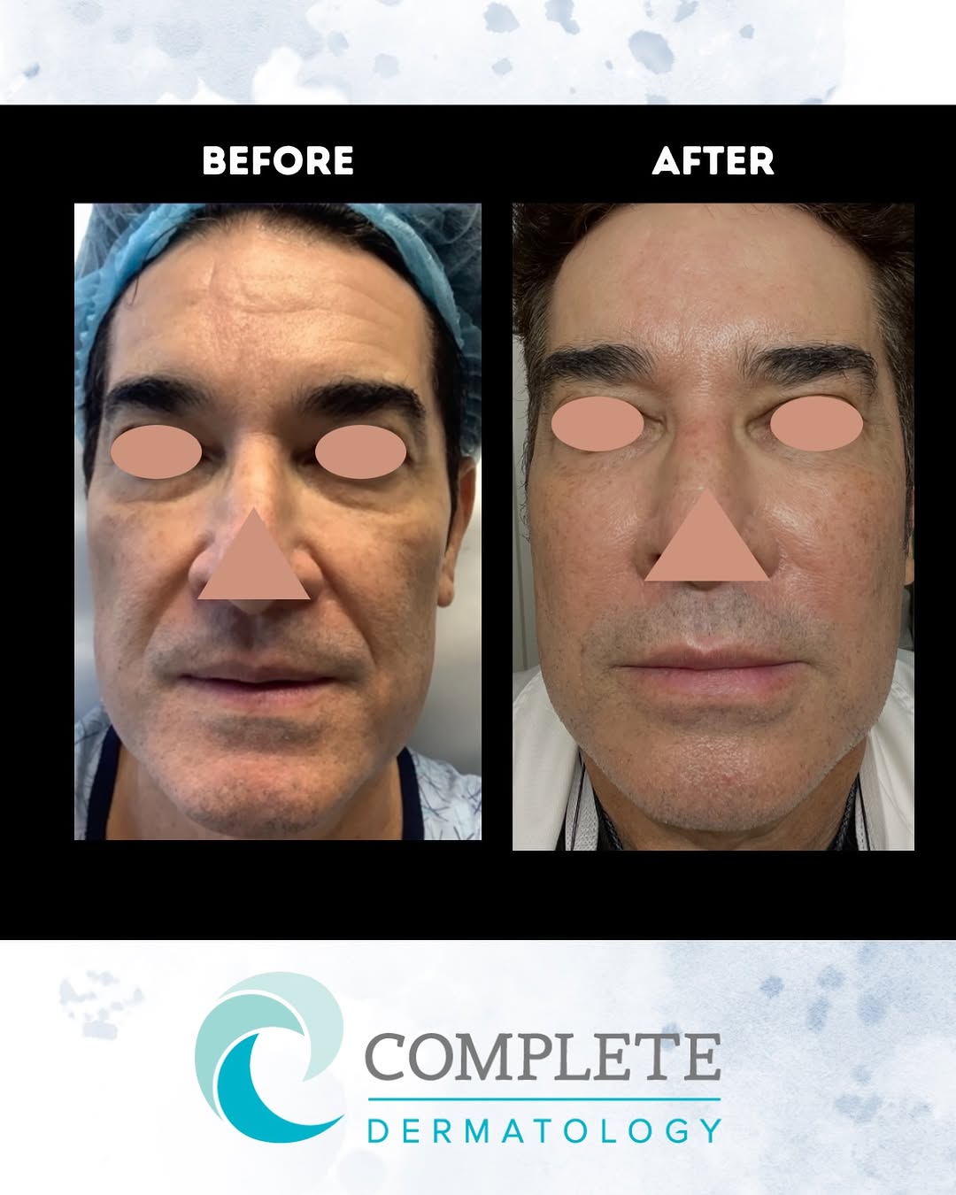 Instagram post by Dr. Alex S. Carcamo: The kind of results that can only come with a customized approach and the RIGHT technologies for YOUR skin. Includes Microneedling with radi…