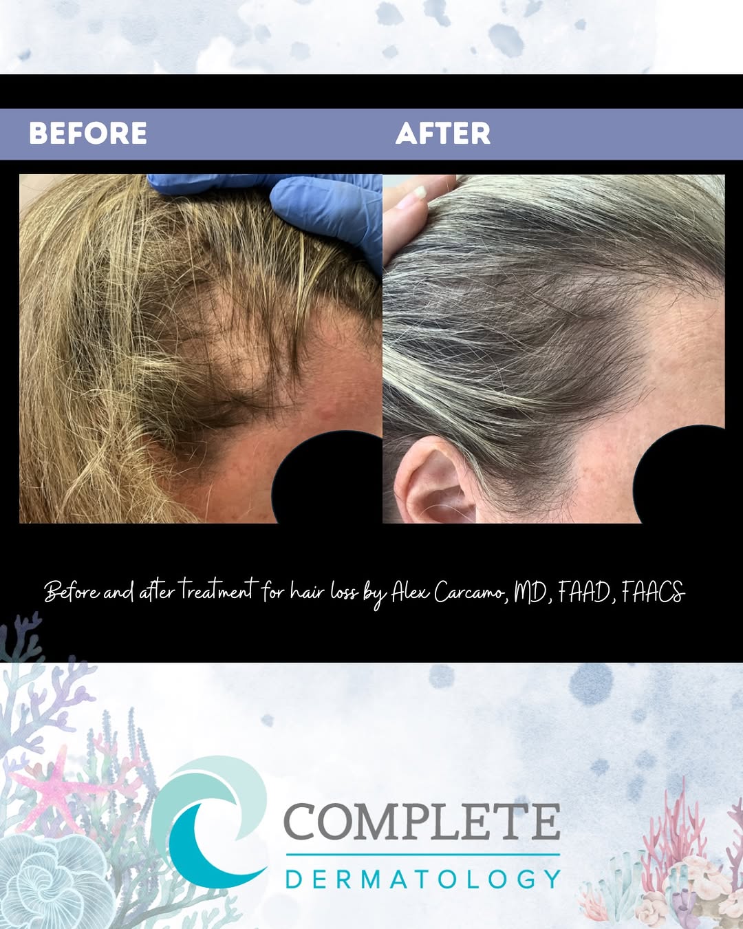 Instagram post by Dr. Alex S. Carcamo: Using a combination of topical and oral medications combined with laser technologies to restore hair growth. Amazing results! 😍🌺 #hairloss…