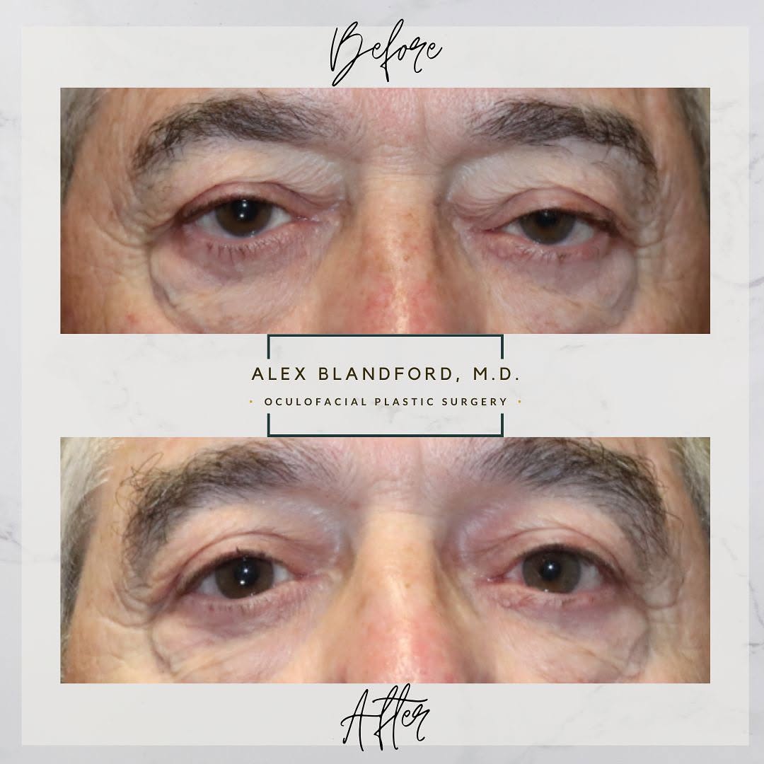 Instagram post by Dr. Alexander Blandford: **** IMPROVING EYELID SYMMETRY WITH UPPER EYELID LIFT **** 👇 👇 👇 This awesome patient was bothered by drooping upper eyelids where the ey…