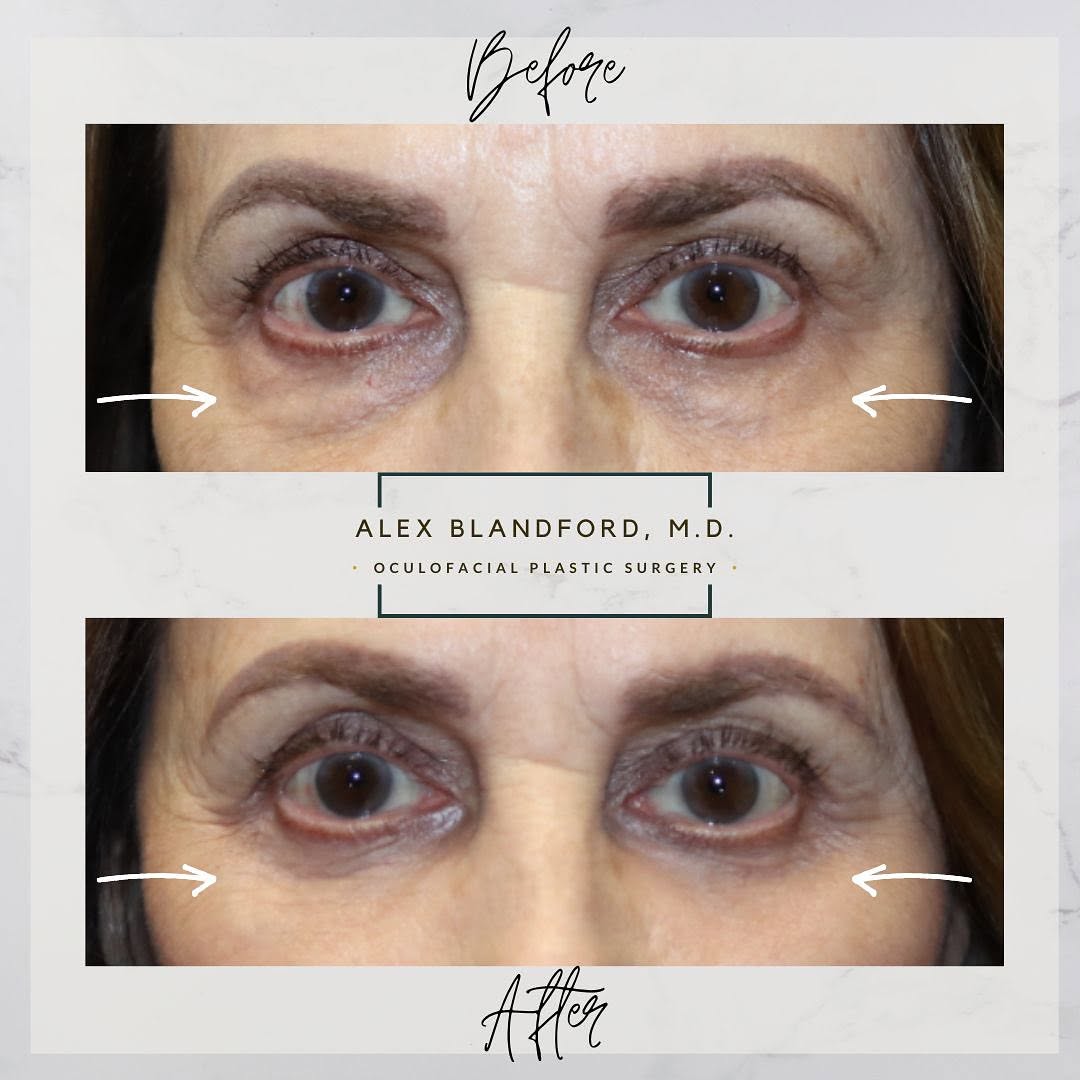 Instagram post by Dr. Alexander Blandford: BEFORE AND AFTER UNDER EYE BAG 👁️ 👁️ 🧳 🧳 SURGERY LOWER BLEPHAROPLASTY 👇👇👇 📣📣 Public Service Announcement: If there are true under e…