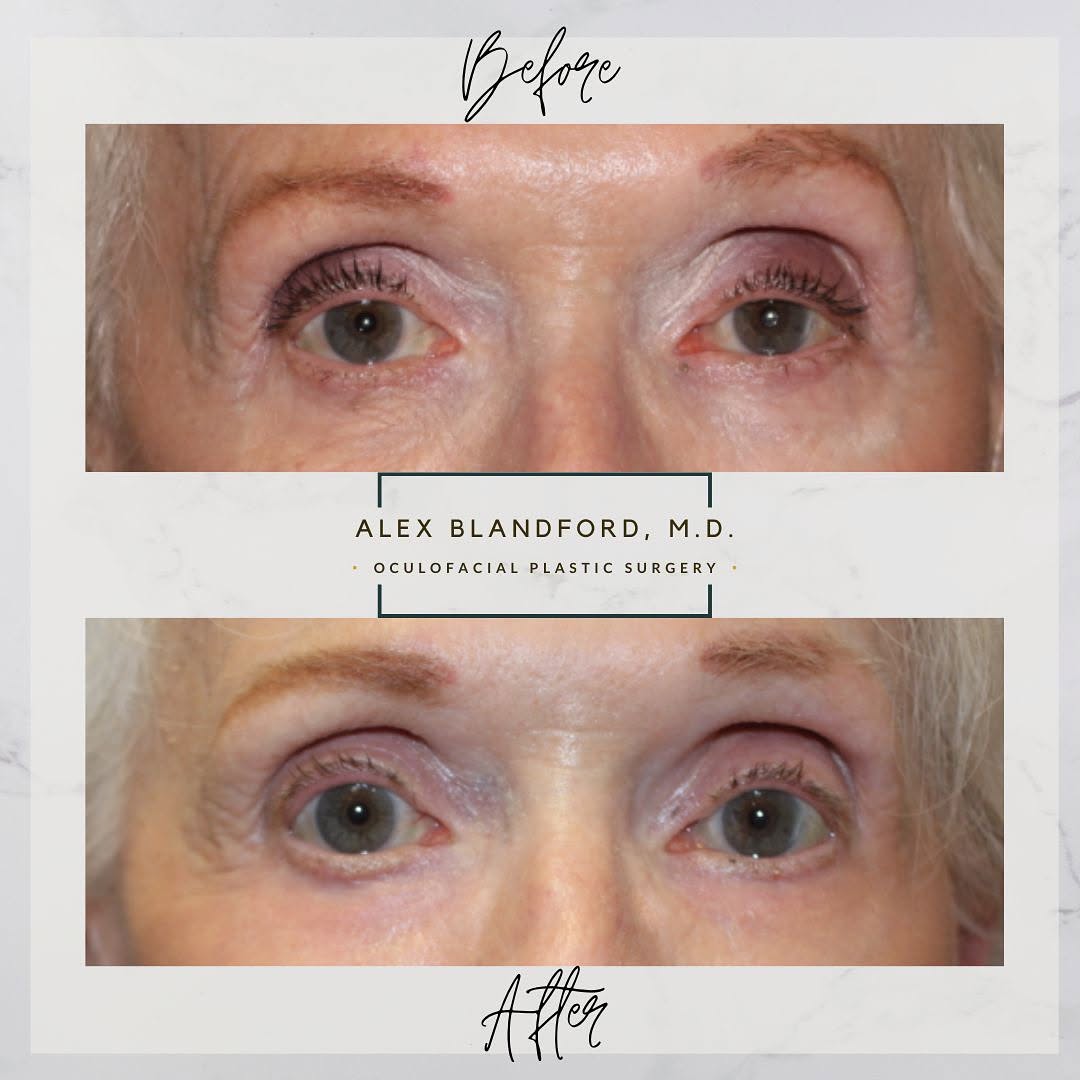 Instagram post by Dr. Alexander Blandford: **** BEFORE AND AFTER UPPER EYELID LIFT ⬆️ (PTOSIS SURGERY) AND LOWER EYELID LASER ⚡️ RESURFACING **** 👇 👇 👇 This lovely patient was both…
