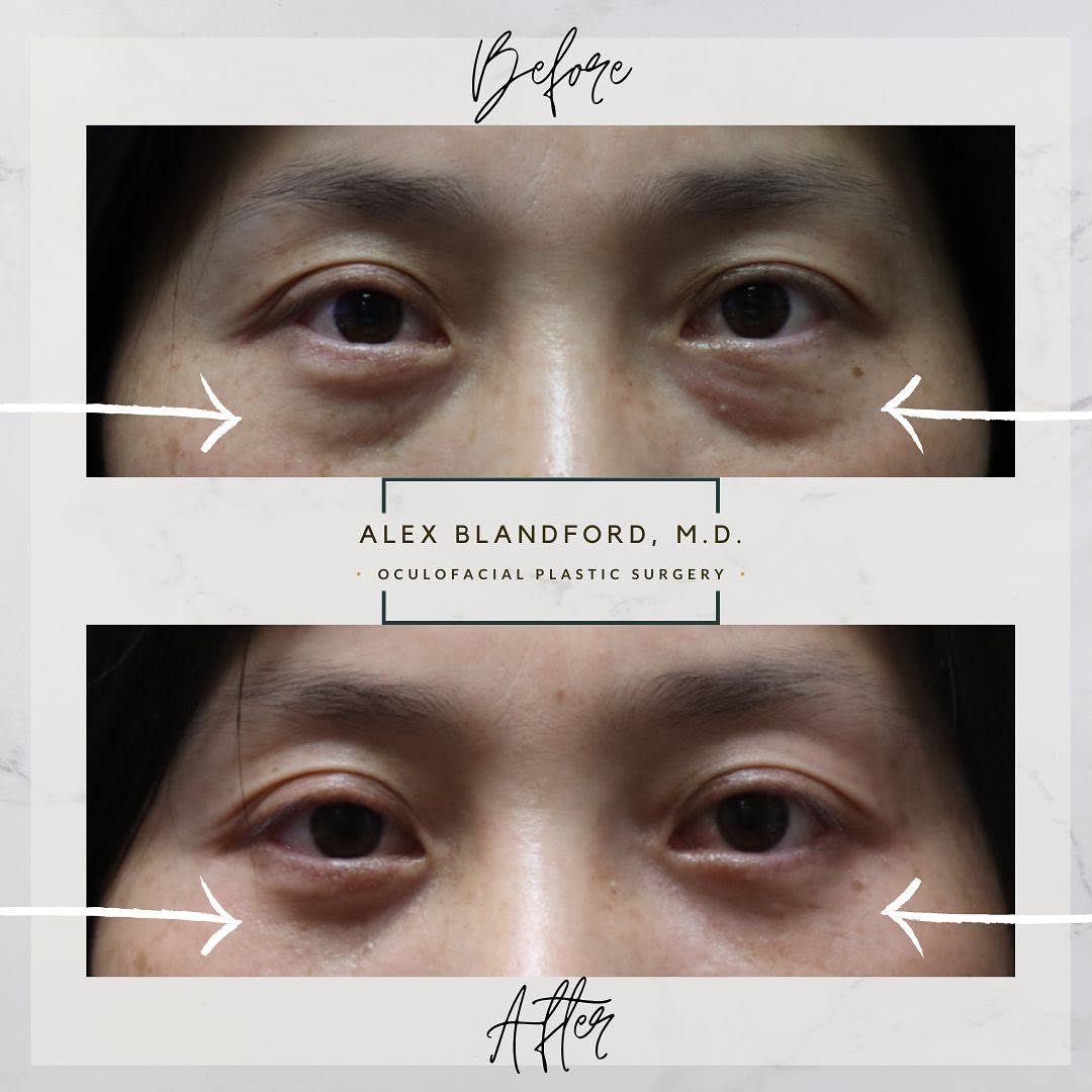 Instagram post by Dr. Alexander Blandford: BEFORE AND AFTER UNDER EYE BAG SURGERY LOWER BLEPHAROPLASTY 👇👇👇 This wonderful patient was bothered by the appearance of her lower eyelid…