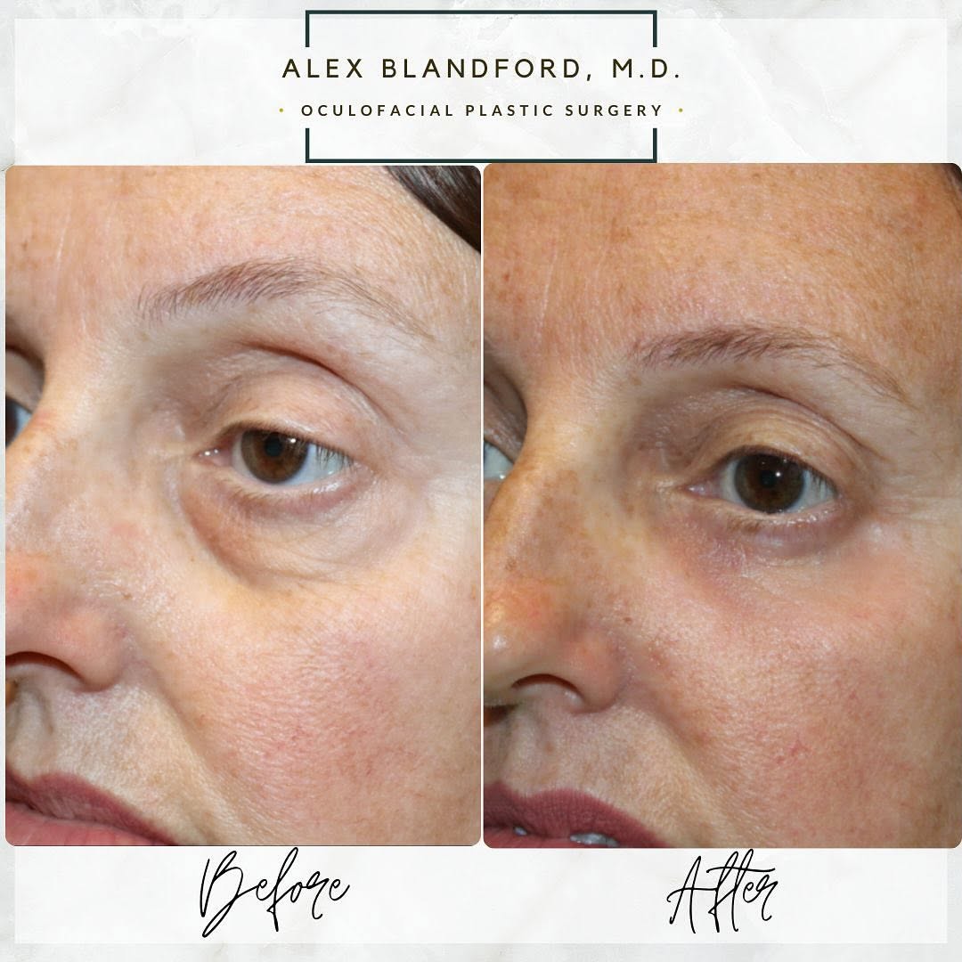 Instagram post by Dr. Alexander Blandford: BEFORE AND AFTER LEFT UPPER EYELID INTERNAL PTOSIS SURGERY AND UNDER EYE BAG SURGERY LOWER BLEPHAROPLASTY 👇👇👇 This beautiful patient trav…