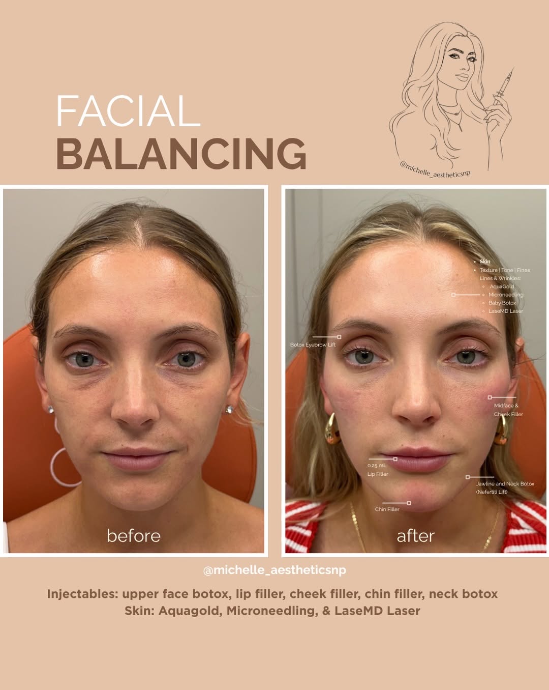 Instagram post by Dr. Alexander Blinski: One of my favorite people 🤍 We’ve worked together to enhance her natural features while keeping everything balanced, harmonious, and her. A…