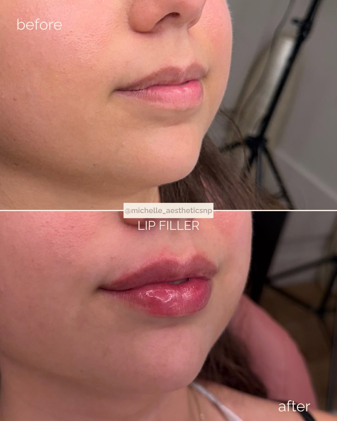 Instagram post by Dr. Alexander Blinski: First time getting lip filler and the results are stunning. We used 0.5mL of #juvederm HA filler. Sometimes a little bit of filler goes a lo…