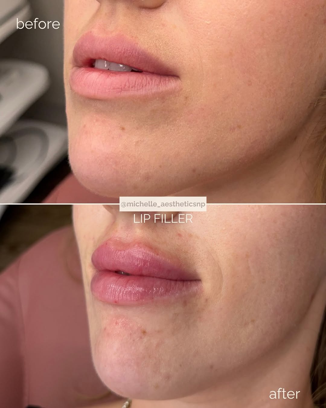 Instagram post by Dr. Alexander Blinski: Subtle volume, enhanced definition, and a beautifully balanced lip shape 💋✨#lipfiller #hoboken #lips #nursepractitioner #facialbalancing