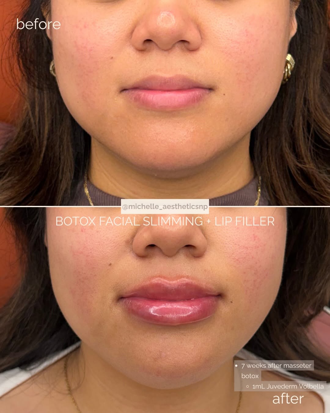 Instagram post by Dr. Alexander Blinski: Beautiful lower-face transformation and facial harmonization after masseter Botox settled, creating a slimmer lower face, paired with lip fi…