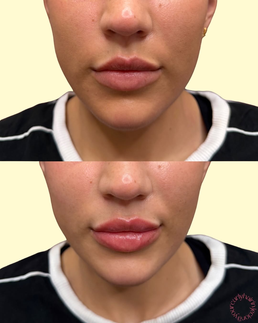 Instagram post by Dr. Alexander Blinski: just the right amount of lip filler 🤩